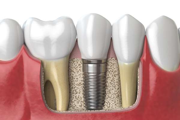 Dental Implants for Replacing Missing Teeth from Korsmo Family Dental in Tacoma, WA