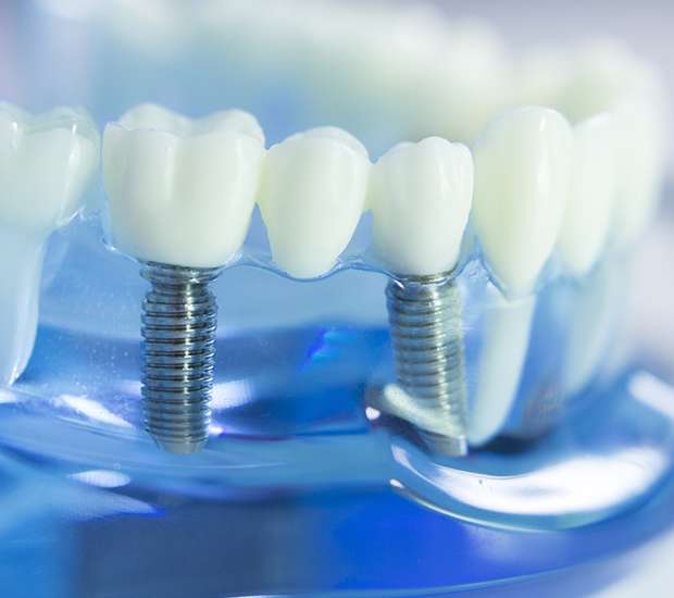Tacoma Dental Implants