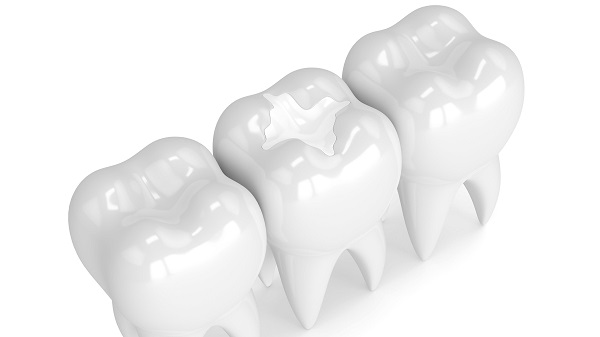 Visit A Dentist To Get Dental Sealants