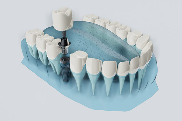 FAQs about Dental Implants from Korsmo Family Dental in Tacoma, WA