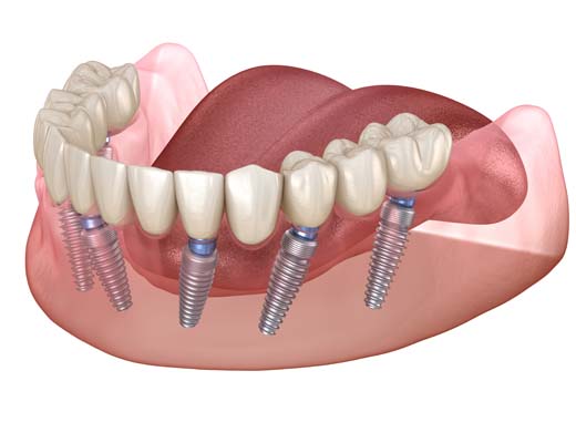 Implant Supported Dentures Tacoma, WA