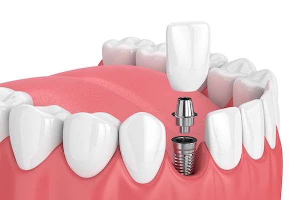 Mini vs. Regular Dental Implants from Korsmo Family Dental in Tacoma, WA