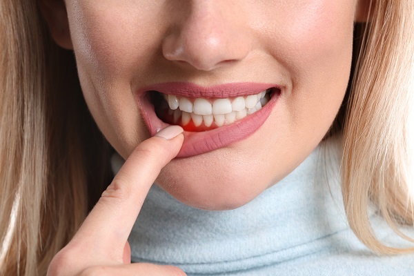 Does Plaque Cause Periodontal Disease?