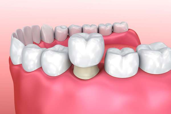 Permanent Dental Crowns vs. Temporary: Is There a Difference from Korsmo Family Dental in Tacoma, WA