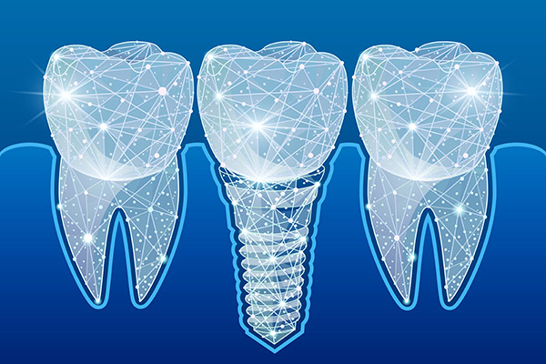 Preventing Complications After Getting Dental Implants from Korsmo Family Dental in Tacoma, WA