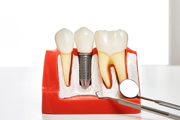 Your Guide to Different Kinds of Dental Implants from Korsmo Family Dental in Tacoma, WA