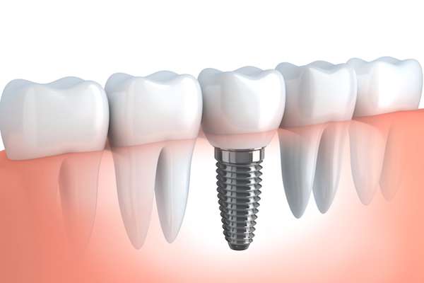 Your Ultimate Guide to Getting Dental Implants from Korsmo Family Dental in Tacoma, WA